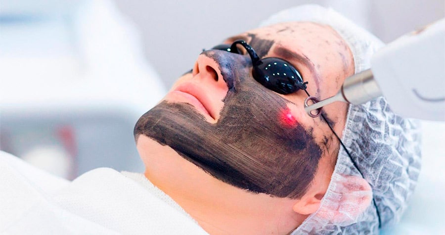 Peeling Hollywood con carbón activado y láser